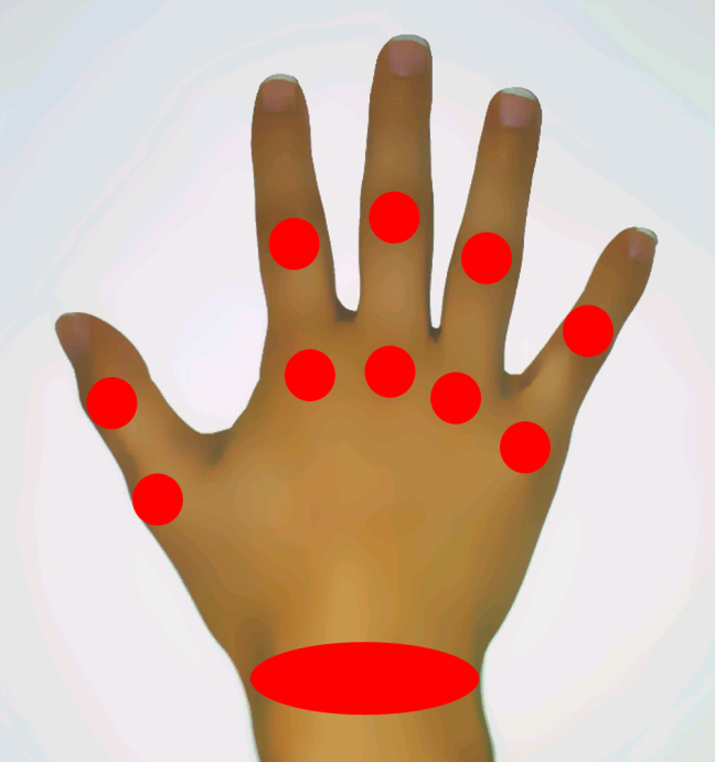 articulações das mãos mais frequentemente atingidas pela AR